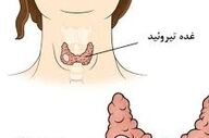 کسانیکه اختلال تیرویید دارند حتما این مطلب مهم را بخوانند!