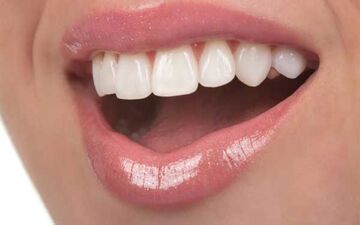 لبخندی درخشان و سفید با پیشگیری و راه های از بین بردن سیاهی دندان
