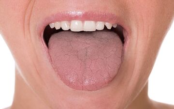 دلیل خشک شدن دهان دیابتی ها چیه؟