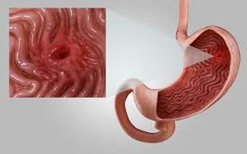 کدام یک از سبزیجات باعث زخم معده میشوند؟