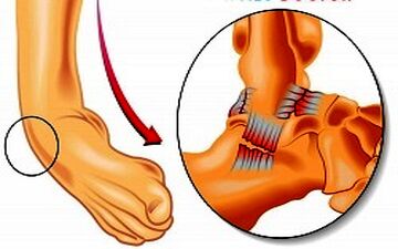  آیا مکررا دچار پیچ خوردگی مچ پا می شوید؟