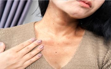 خطرناک‌ترین نشانه مصرف زیاد قند چیست؟ مراقب این تغییر عجیب پوستی باشید