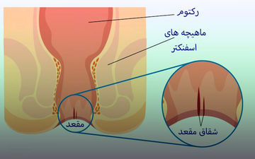 جوش خوردن زخم شقاق