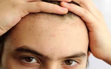  اگر پیشانی تان جوش میزند،راه حل آن اینجاست