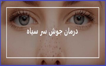 درمان جوش های سرسیاه