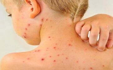 کاهش میزان واکسیناسیون آمار ابتلا به سرخک را افزایشی کرد