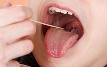 نقش لوزه‌ها در سیستم ایمنی بدن