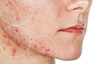 برای سلامت پوست چکار کنیم؟| لمس صورت باعث بروز و یا تشدید آکنه می شود؟