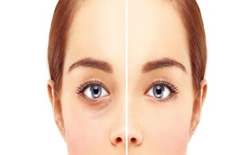 نکاتی مهم برای افرادی که قصد جراحی پلک دارند