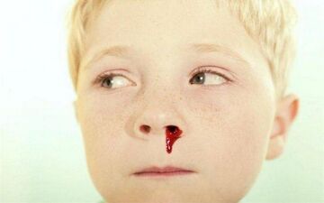 چرا خون دماغ می شویم؟