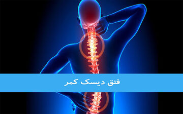 درمان فتق دیسک کمر