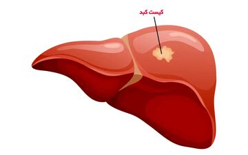 خطر سرطانی شدن کیست‌های کبدی چقدر است؟