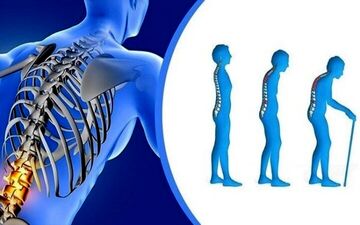 از پوکی استخوان چگونه می توان جلوگیری کرد؟

