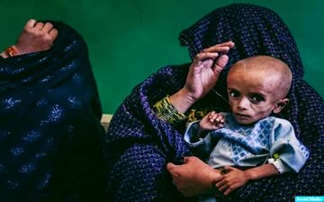 ابتلای نیمی از کودکان زیر ۵ سال افغان به سوء تغدیه شدید