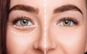 طبق دستورات طب سنتی چگونه پف زیر چشم را از بین ببریم؟