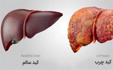 از علت تا درمان کبد چرب
