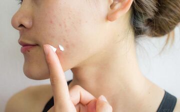 جوش‌های تابستانی: چرا ایجاد می‌شوند و چگونه آن‌ها را درمان کنیم؟
