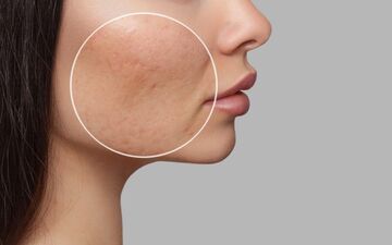 با این ترفندها از شر منافذ باز پوستی راحت شو!| به پوست صاف و زیبا سلام کن