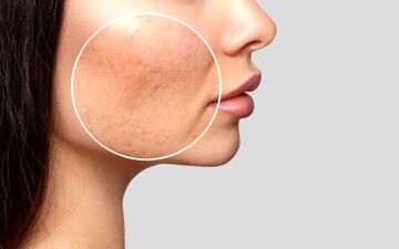 با این ترفندها از شر منافذ باز پوستی راحت شو!| به پوست صاف و زیبا سلام کن