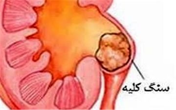  این خوراکی ها سبب سنگ کلیه می شوند 