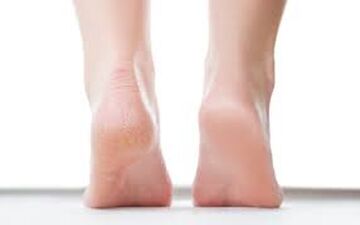 چرا نگهداری از پا در گرما اهمیت دارد؟