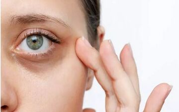 تیرگی دور چشم به چه علت است؟
