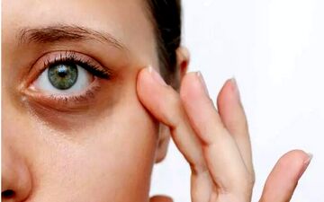 تیرگی دور چشم به چه علت است؟
