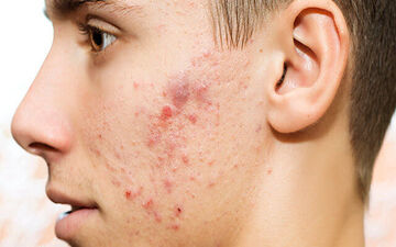 جوش زدن در هر قسمت از صورت نشانه چیست؟