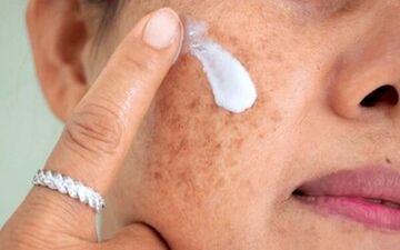 لکه‌های پوستی درمان می شوند؟

