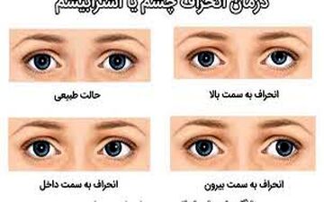 انحراف چشم مخفی و این درمان ها