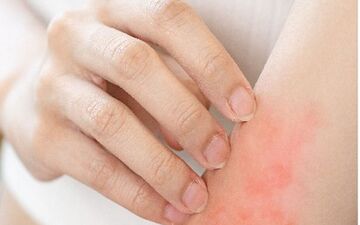 جایگزین های امن برای خاراندن| هنگام خارش ناشی از اگزما چکار کنم؟