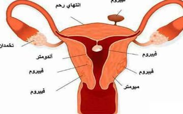 مهمترین دانستنی ها در مورد فیبروم رحمی!