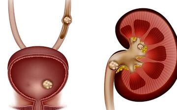با این موارد دم دستی سنگ کلیه را پودر کنید