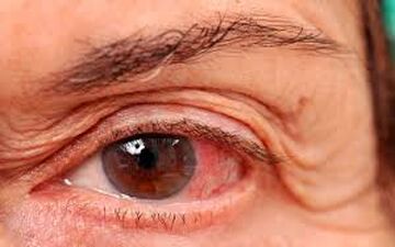 چرا به آب سیاه مبتلا می شویم؟