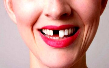 تعبیر دیدن افتادن دندان در خواب چیست؟ | تعبیر خواب افتادن دندان