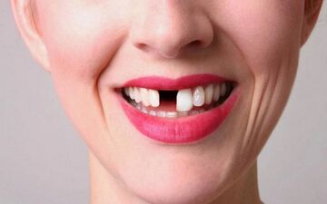 تعبیر دیدن افتادن دندان در خواب چیست؟ | تعبیر خواب افتادن دندان