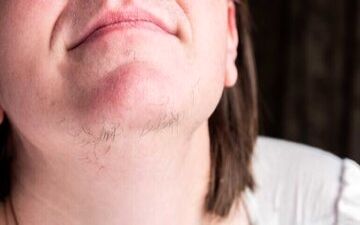 رویش مو در چانه زنان به چه علت است؟
 

