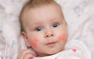 کمبود ویتامین  D موجب اگزما در کودکان می‌شود