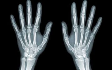 روشی جدید برای مقابله با متاستاز استخوانی