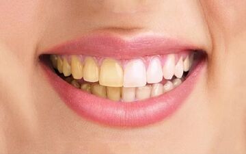  زردی دندان‌ها نشانه چیست؟