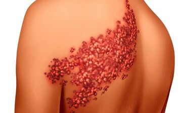 زونا در کمین چه کسانی است؟