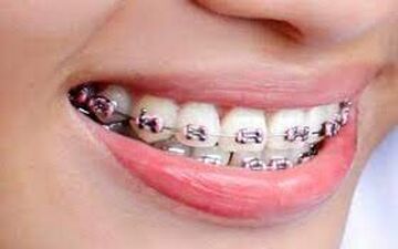 بایدها و نبایدهای ارتودنسی 