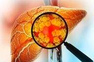 کبدت چند درجه چرب شده؟ اینفوگرافیک + درجه‌بندی واقعی!