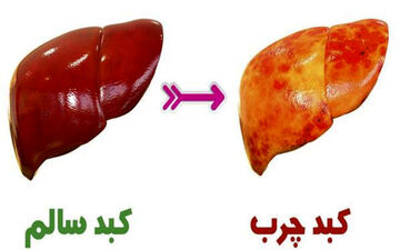 نکات مهم در تغذیه افراد مبتلا به کبد چرب