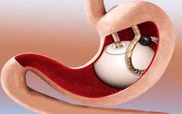 عمل بالون معده خطرناک است؟ 
