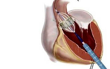 علائم تنگی دریچه آئورت