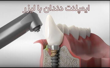 همه چیز درباره ایمپلنت دندان با لیزر