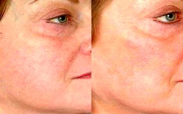 دلایل ایجاد رگ‌های عنکبوتی بر روی صورت چیست؟ + درمان 