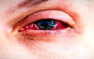شیوع کرونای جدید در ایران/ این علائم را دیدید سریع به دکتر مراجعه کنید