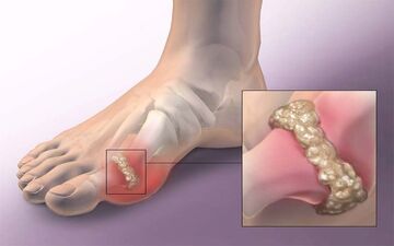 نقرس چیست و چه درمانی دارد؟